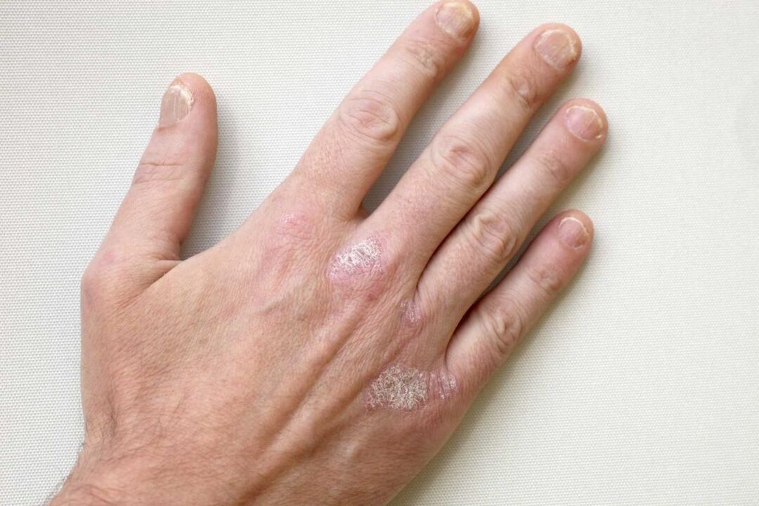 psoriazės ant vyro rankų gydymas Keramin kremu