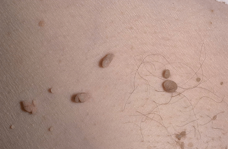 Papiloma