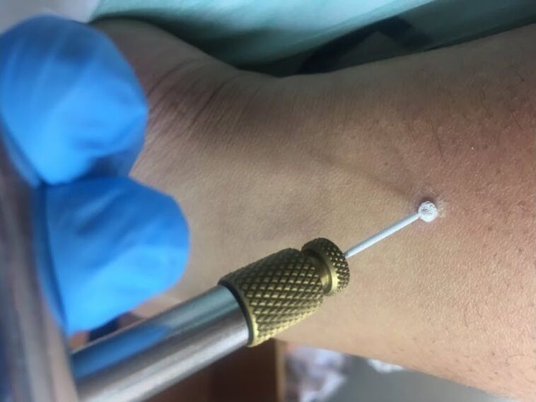 karpų pašalinimo būdai