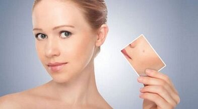 veiksmingų karpų ir papilomų gydymo priemonių apžvalga