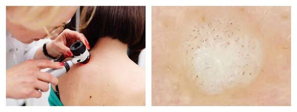 Karpos dermatoskopija