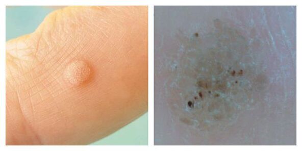 Įprasta karpa tyrimo metu ir dermatoskopija