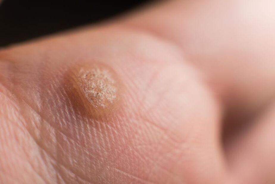 žmogaus papilomos virusas ant odos